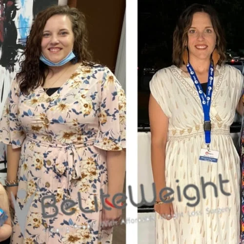 Weight Loss Surgery Before And After
